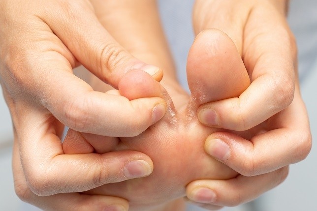 Mycose des ongles de pied : cause et traitement