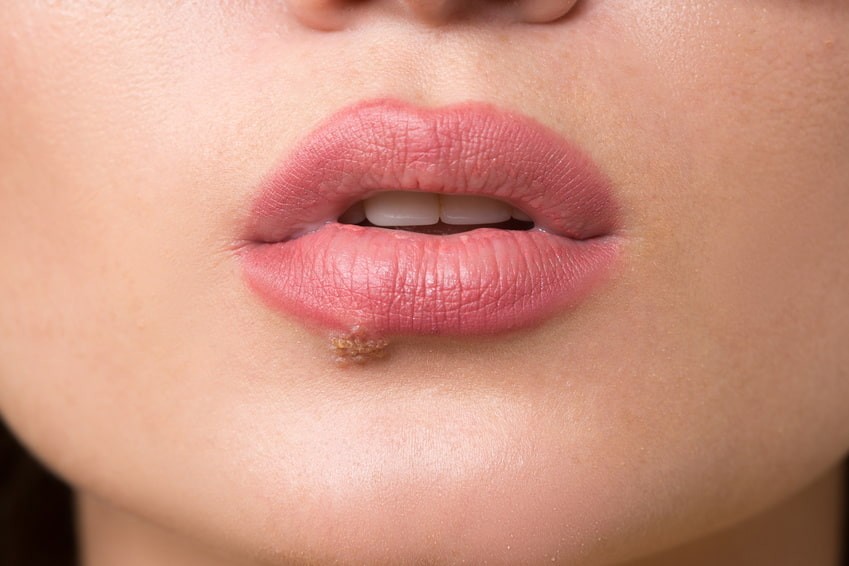 Herpes Labial Comment Soigner Un Bouton De Fievre